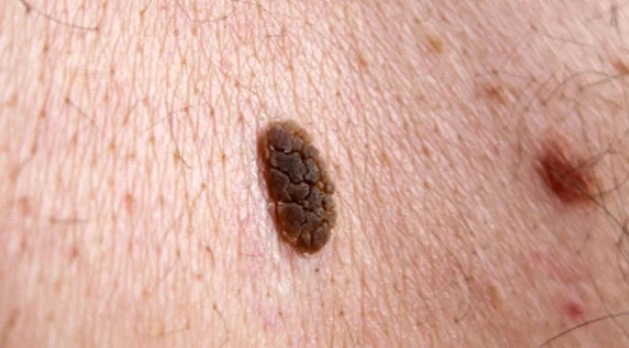 검버섯 없애는 방법