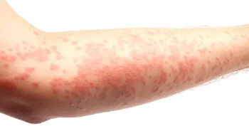 피부 붉은반점 15