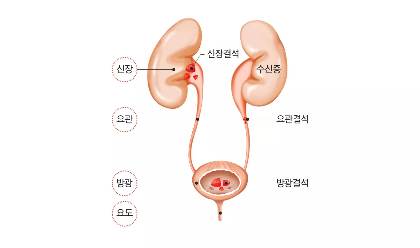 요로결석 사진