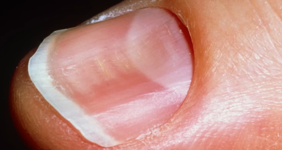 손톱에 세로줄이 생기는 이유