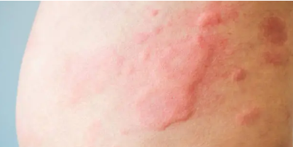 알레르기 관련 사진