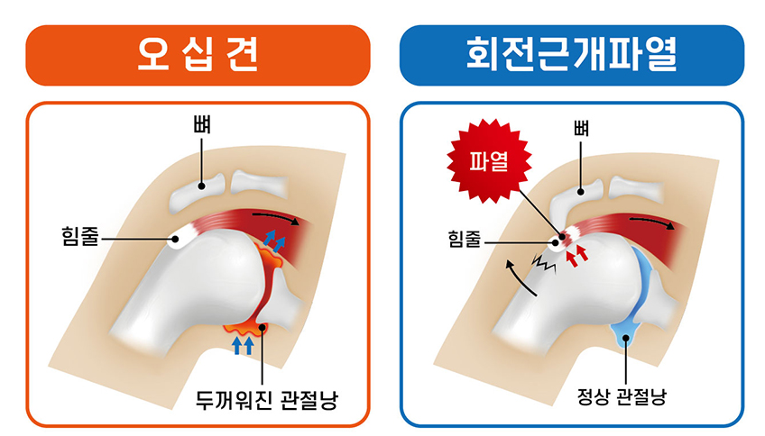 오십견과 회전근개파열 차이 구분법