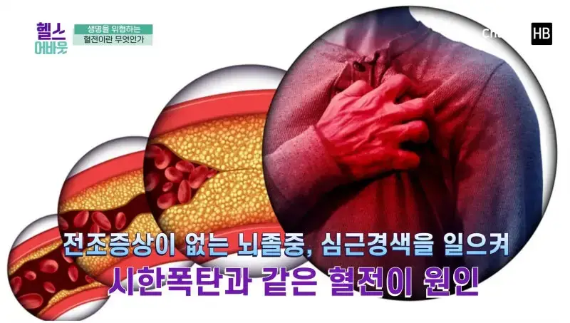 혈전용해제 나토키나제