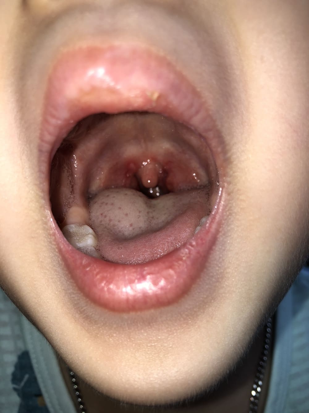 둘째아이 입안궤양