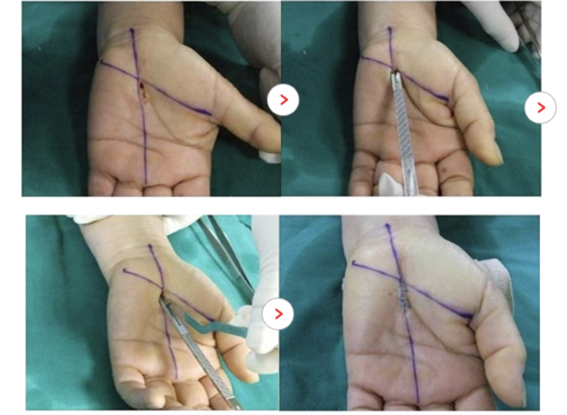 손목터널증후군수술-수근관증후군수술-손목통증-carpaltunnelrelease