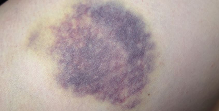 피부에 멍이 든 모습