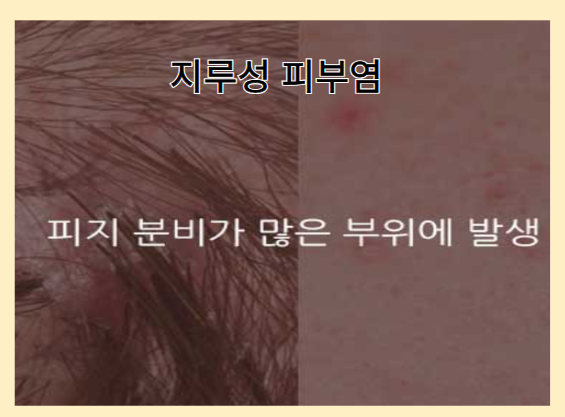 탈모를 악화시키는 나쁜 습관 - 지루성 피부염