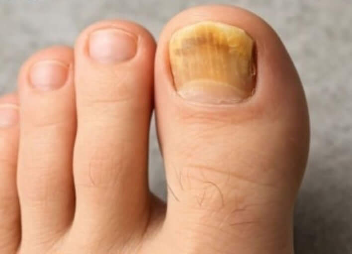 발톱무좀 없애는 방법