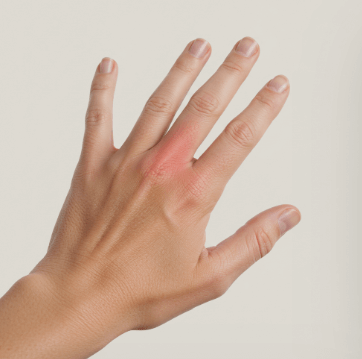 손목터널증후군 증상 및 치료법5