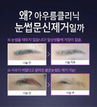 눈썹 문신 제거 방법 꿀팁_6