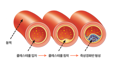 고혈압 이미지