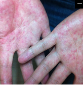 가려움, 발진, 붉어짐 등 불쾌한 증상을 동반한 접촉성 피부염