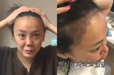 머리카락 이식 3000모 3000모낭 비용과 시술 과정_7