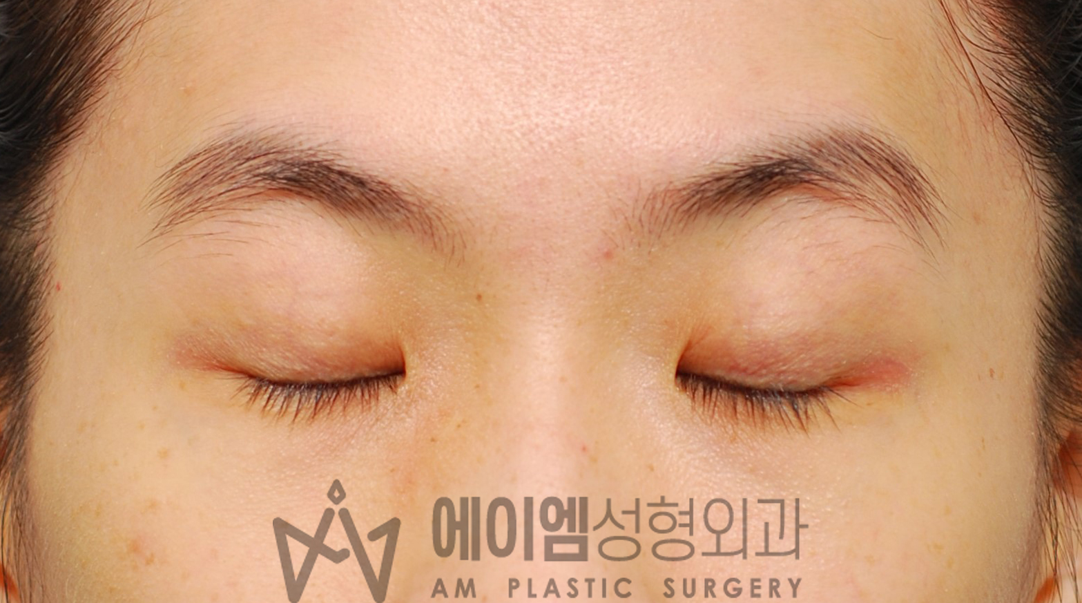 수술 전 눈감은사진 (쌍수 풀기 전)