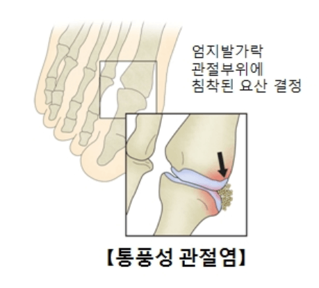통풍