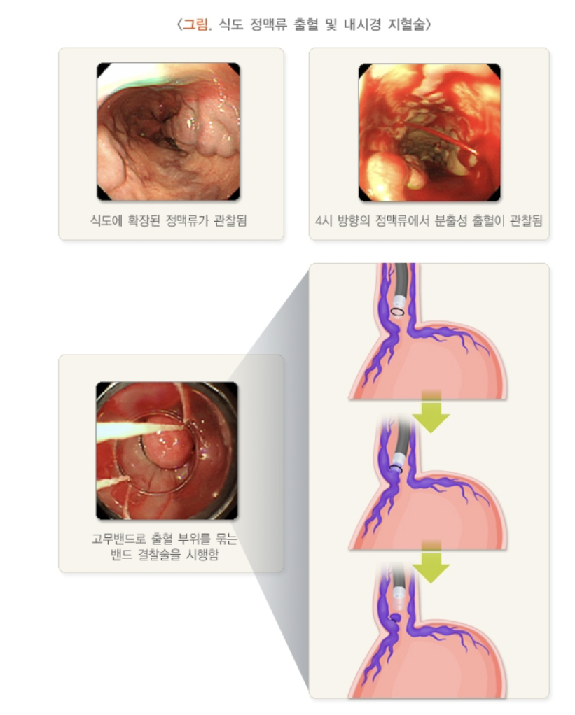식도 정맥류 수술
