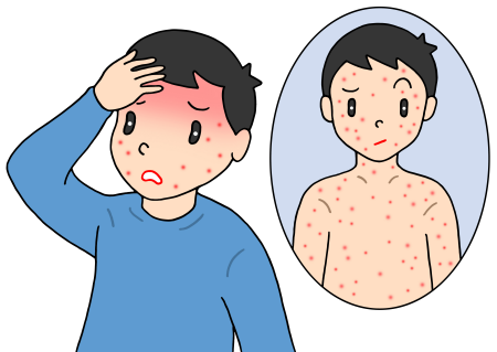 홍역 measles