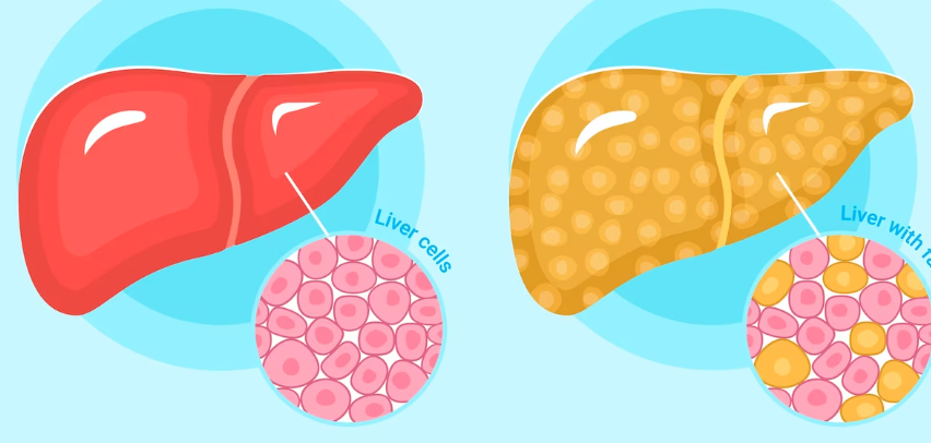 담도 폐색을 치료하는 방법 약물치료