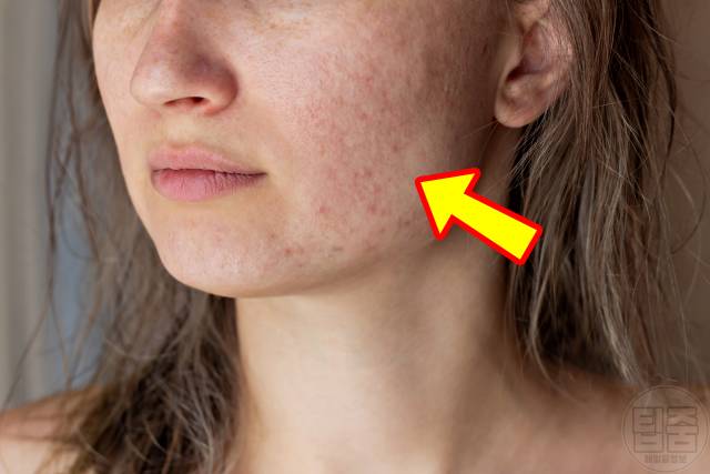 베개커버 세탁 주기 피부과 전문의 추천 베개커버 교체주기 여드름