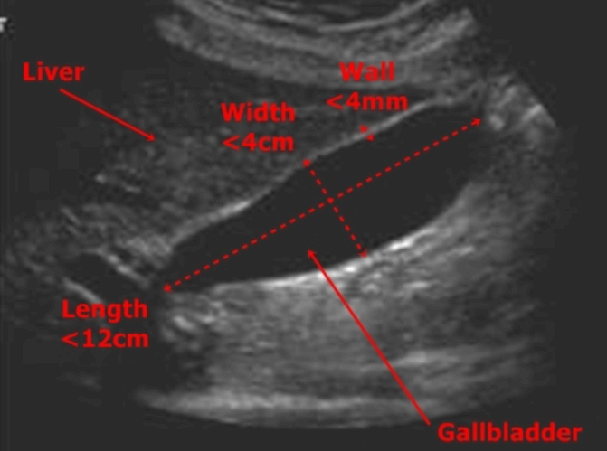담낭 해부학 (GB anatomy )