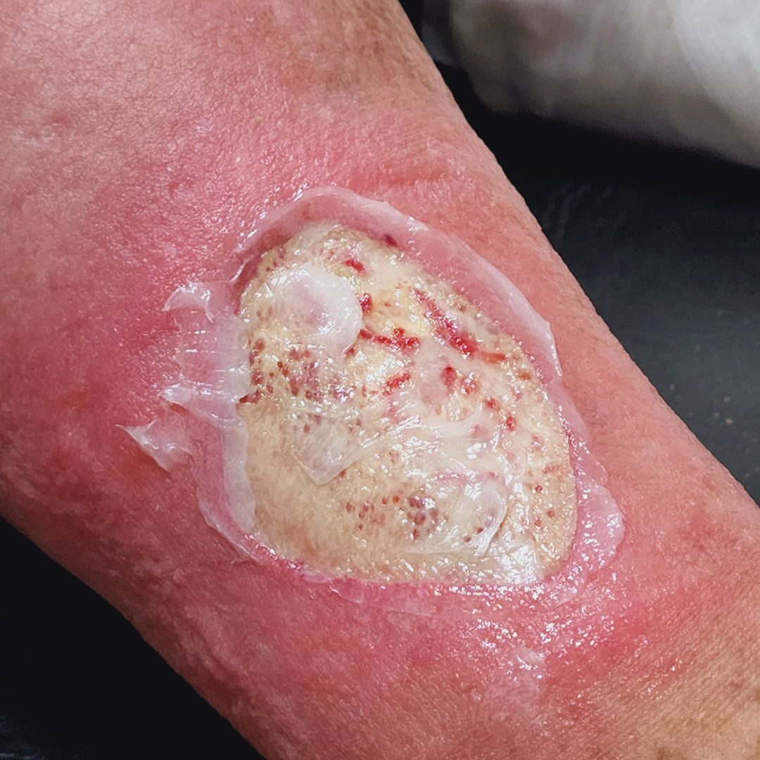 욕창 예방 치료 증상 원인