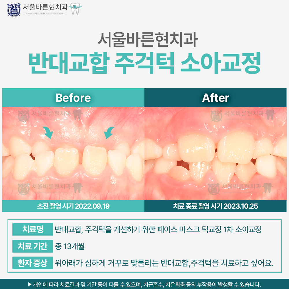 마린시티소아교정