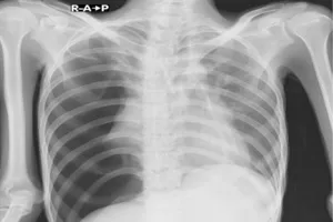 가슴-통증-원인