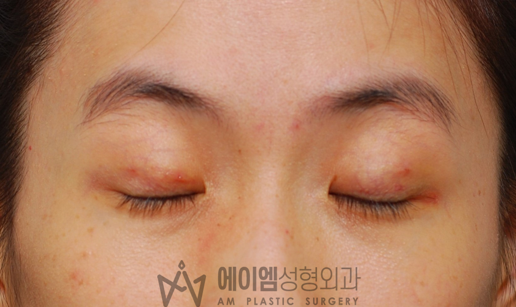 수술 후 4일 눈감은사진 (쌍수 풀기 후)