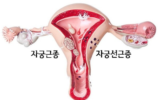 자궁근종, 자궁선근증 관련 이미지