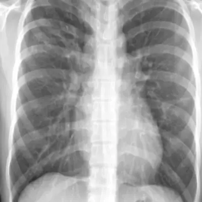 결핵-증상-원인-건강