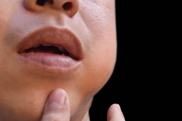 침샘비대증&#44; 턱살이 많다면? 침샘보톡스 치료를 많이 진행하고 있습니다. 여자라면 한번쯤 사각보톡스 이름을 들어봤을 텐데요. 주기적으로 사각 보톡스를 맞는 사람들이 늘어나고 있습니다. 그렇다면 침샘비대증은 무엇이며 원인과 치료방법은 무엇인지 참고하시기 바랍니다.