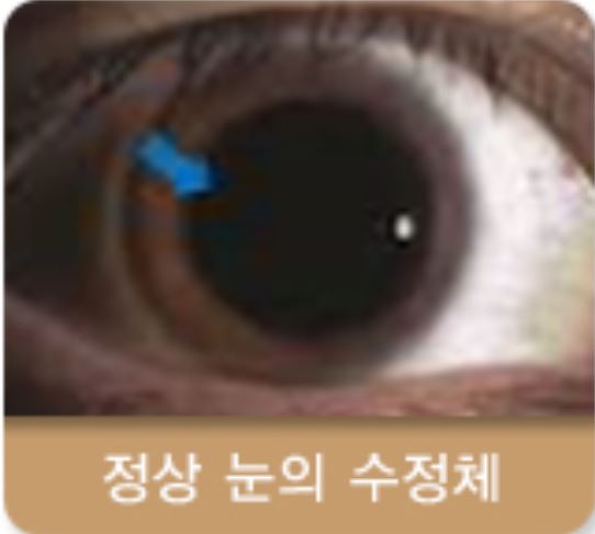 백내장 수술후 주의사항