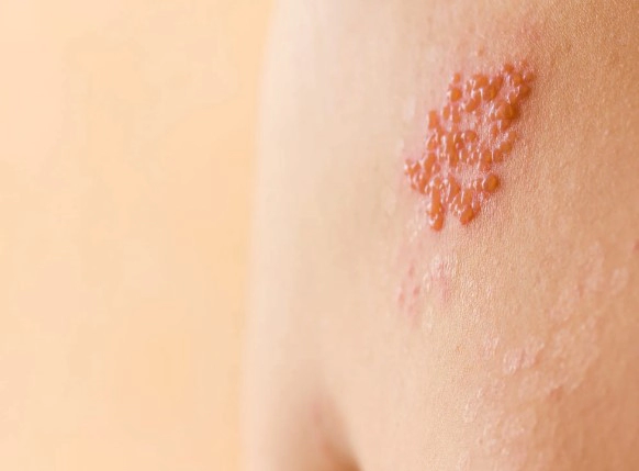 대상포진 초기증상 4가지 및 대상포진 전염성과 병원 예방접종 가격 정리