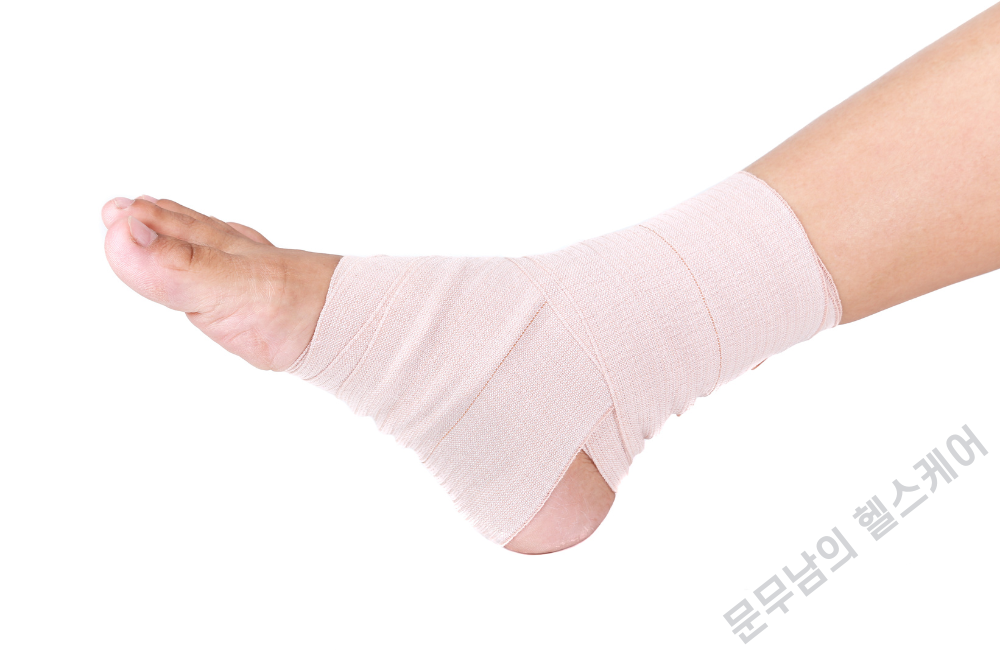 발등 염좌 치료