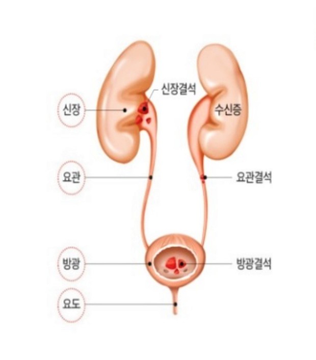 신장결석 위치