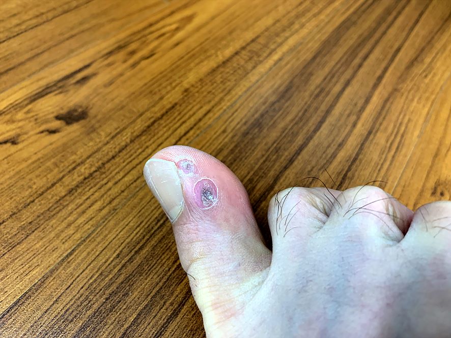 엔트와츠를 바른 뒤 효과를 보이고 있는 엄지발가락