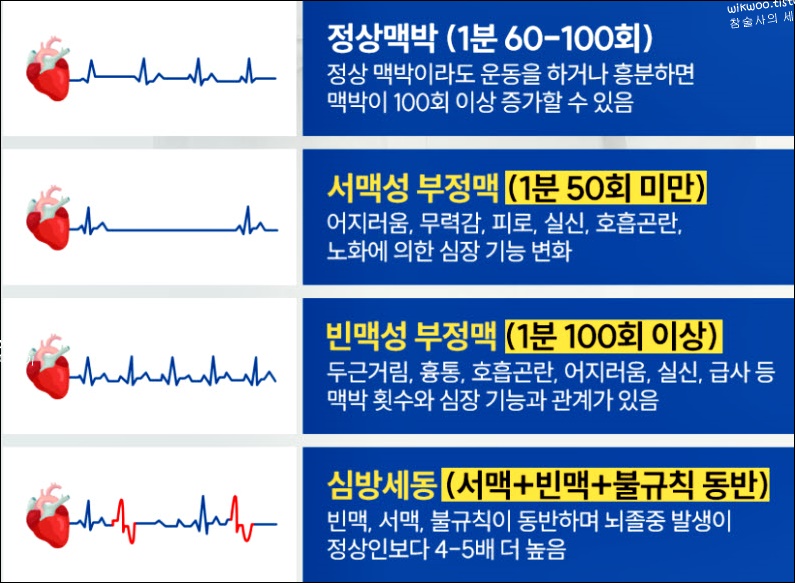 심방세동 부정맥 차이