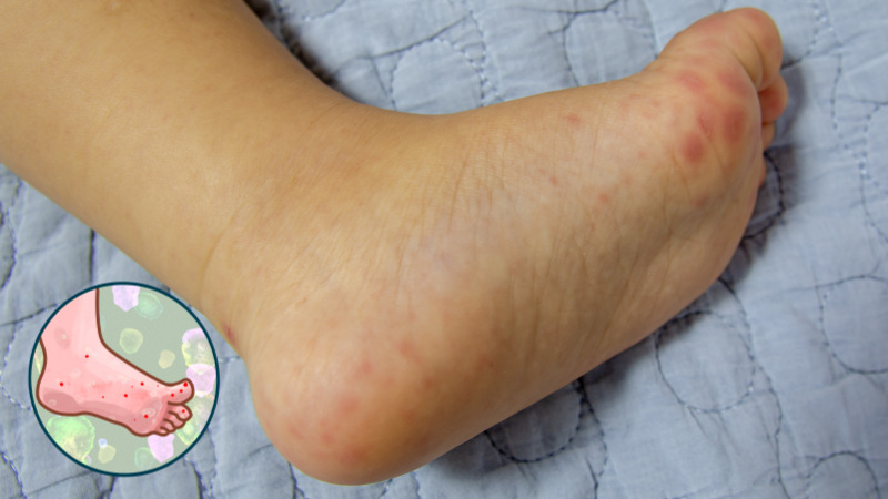 수족구병 진단받은 아이와 보호자