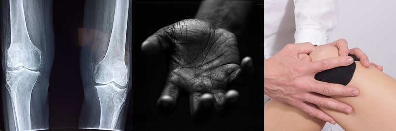 류마티스 관절염, 무릎, 손