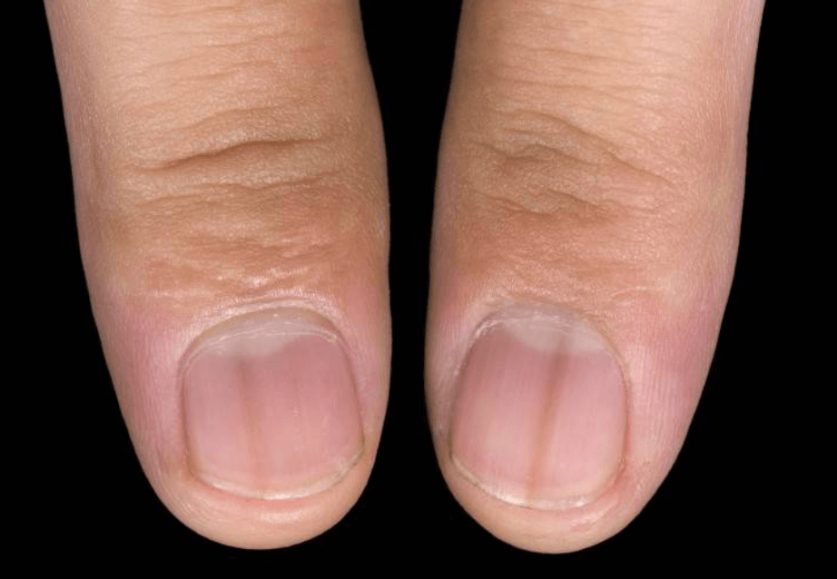 손톱 세로줄 원인