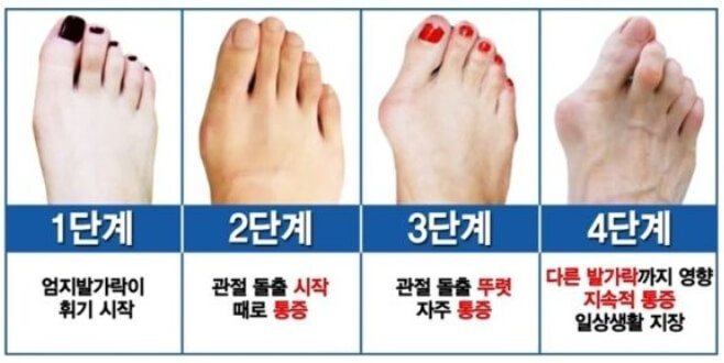 무지외반증 진행 증상별 수준