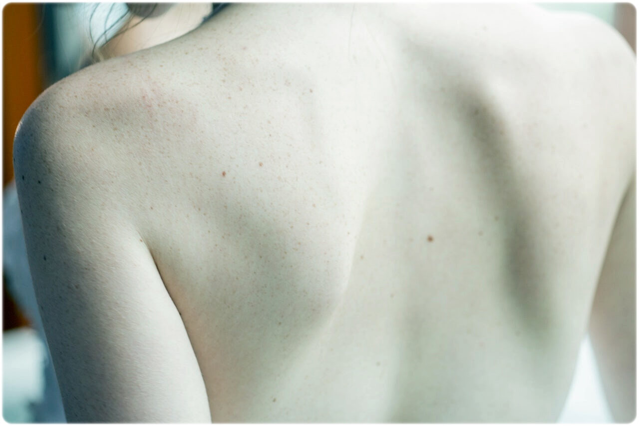 피부암 초기증상 원인 종류 진단 및 치료 방법 예방 방법