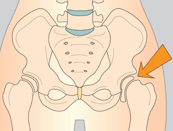 고관절 통증 증상 2
