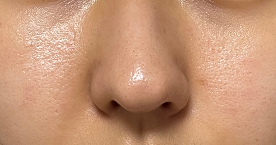 성분에디터 그린토마토 포어리프팅 앰플플러스 사용 9주차(8/13사진)