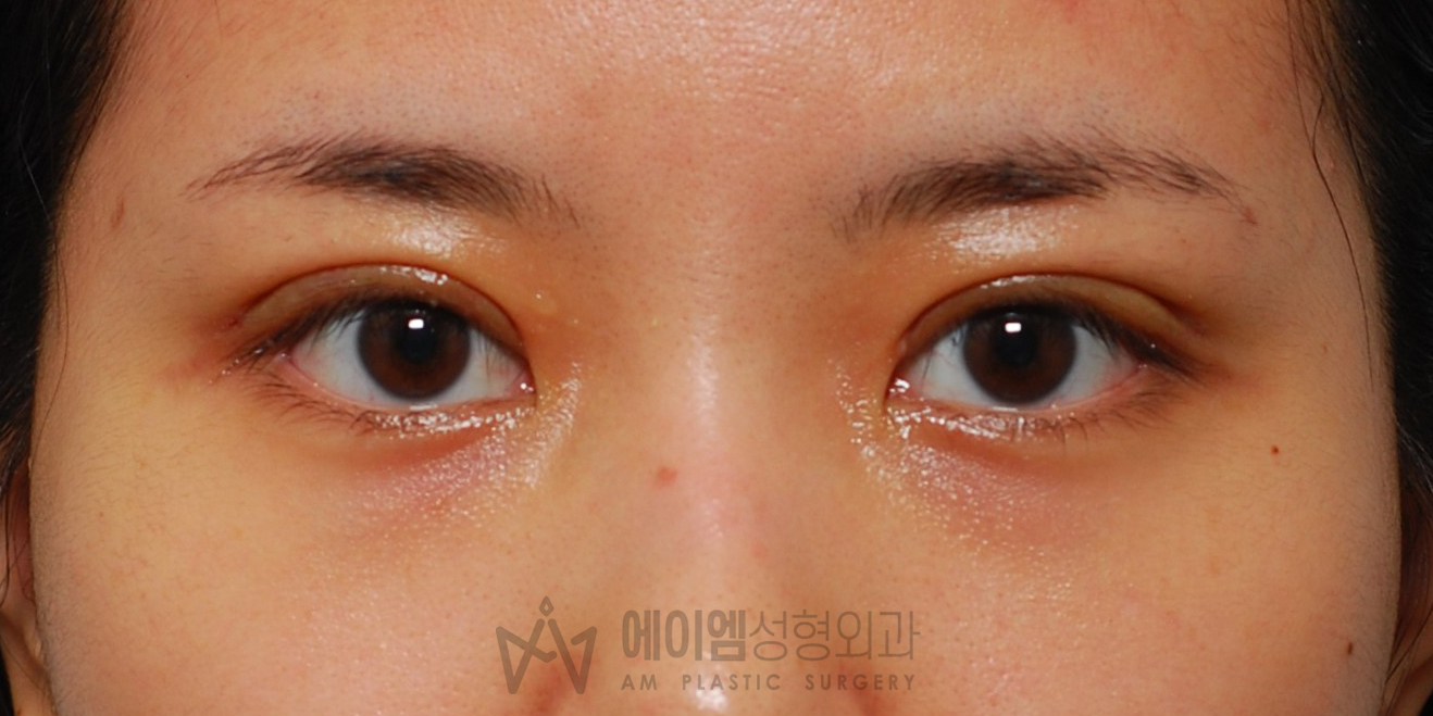 쌍수 붓기 1주 (절개법)
