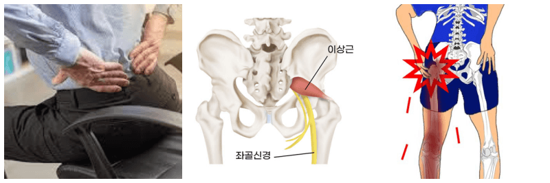 허리통증, 이상근 증후군 사진