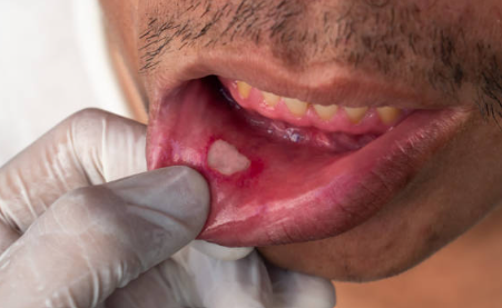 혓바늘 돋는 이유 및 없애는 법 (+ 약 치료법 꿀)