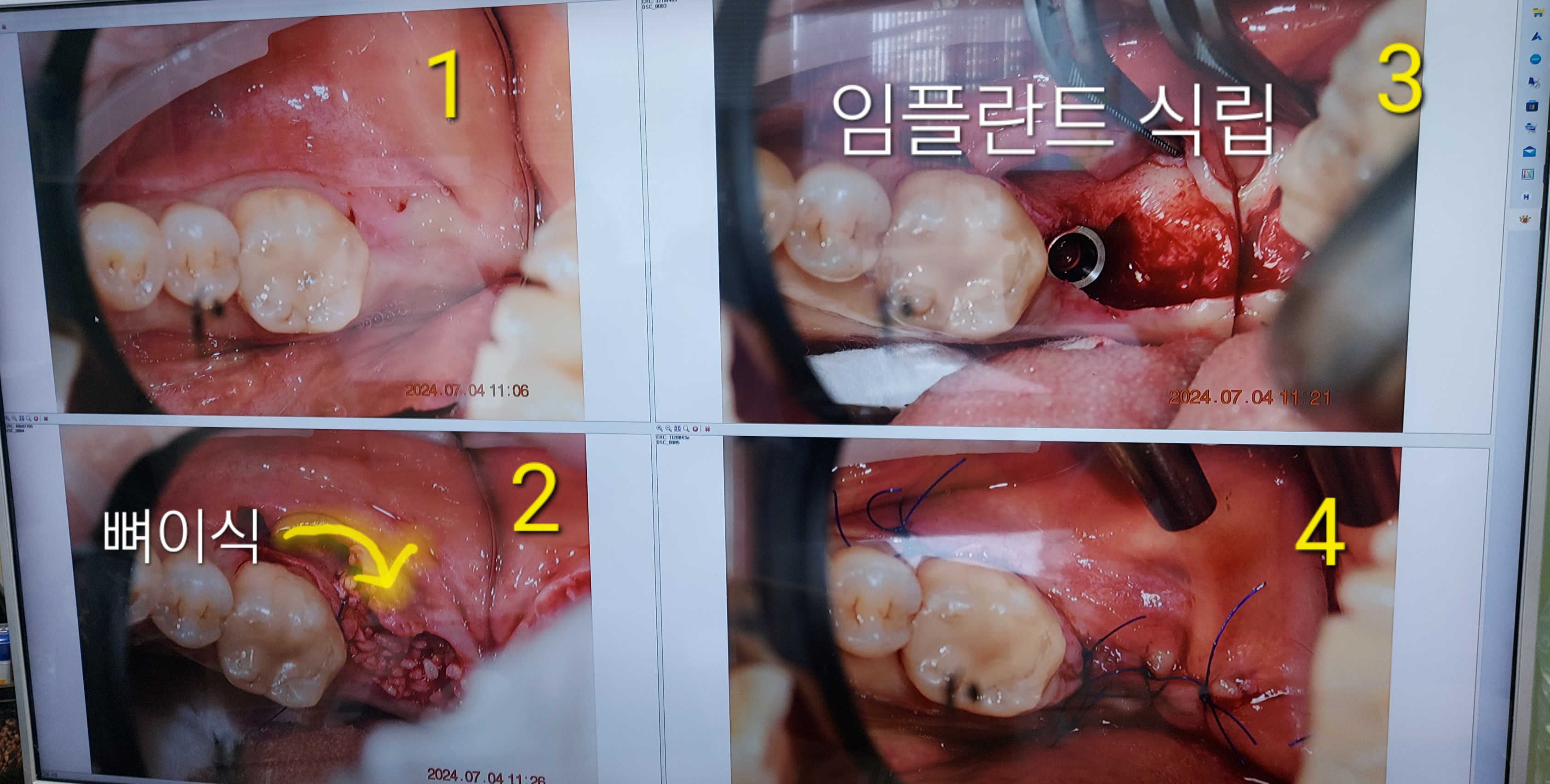 임플란트 시술과정