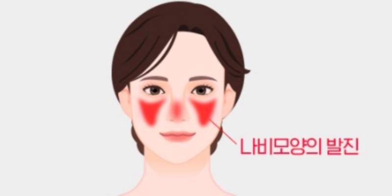 루푸스병 이란 최준희 루푸스 증상 진단 검사 치료 방법 정리