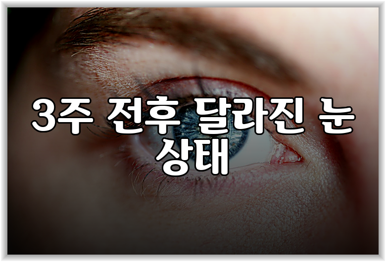 3주 전후 달라진 눈 상태